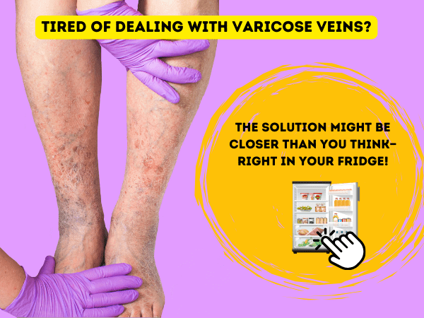 Tired Of Dealing With Varicose Veins?