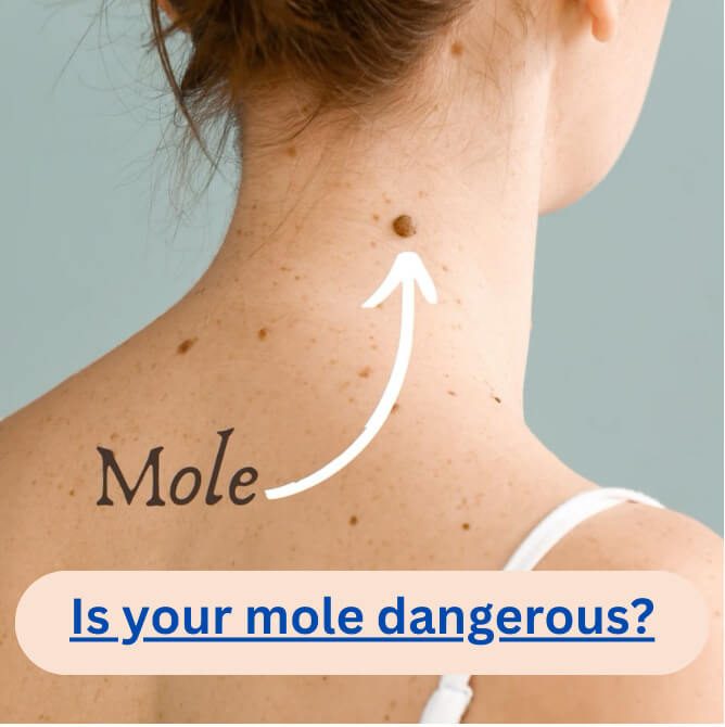 Is Your Mole Dangerous?